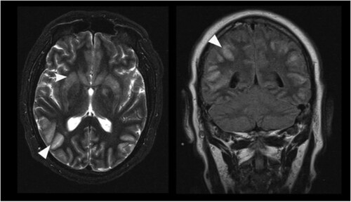 Figure 5. Axial T2 weighted image (left) and coronal FLAIR image (right) of patient B on day 44. Prominent cortical hyperintensities and swelling of cortical grey matter (arrowheads) dominate over signal increase of the basal ganglia (arrow) in this patient.