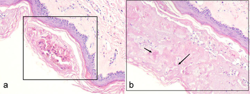 Figure 2 Histopathologic images of the patient’s skin lesions (HE × 100). (a) Microscopic evaluation revealed the presence of blister-like formations beneath the stratum corneum, characterized by the presence of loosened spinous cells. There was a mild disintegration observed at the base of these structures, coupled with a discernible lymphocytic infiltration encircling the periphery. (b) Disintegration of blisters and balloon-like degeneration of cells with a little inflammatory cell infiltration are seen under the stratum corneum. The arrows in the figure indicate cellular balloon-like degeneration.