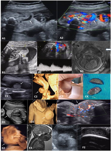 Figure 1. A: (case 17) cervical cutaneous hemangioma at 27 weeks gestation. A1, a mixed mass mainly in the front neck, with a size of about 56 × 33 × 56 mm and internal tubular anechoic signals (arrow). A2 shows abundant blood flow signals within the mass by the color Doppler (arrow). B: (case 5) B1, a mixed echogenic mass was seen in the left shoulder, left axillary area, and left chest wall, with a size of about 58 × 41 × 40 mm, with internal honeycomb echoes (arrow). B2, the rich blood flow signal can be detected internally, with burr-like blood flow spectrum. B3, unenhanced MRI SSFSE sequence shows multiple tortuous vessels with low signal intensities (arrow). C: (case 1) C1, at 23 weeks of gestation, a solid uniform echogenic mass, with a size of 22 × 17 × 19 mm and clear borders, was detected in the dorsal side of right lower leg (arrow). C2, three-dimensional reconstruction (arrow). C3, after birth. C4, surgical resected specimens (arrow). D: (case 12) D1, a hyperechoic well-circumscribed mass in the precordial area of the left chest wall, about 27 × 18 × 33 mm and regular shape (arrow). D2, three-dimensional reconstruction (arrow). E: (case 14) at 35 weeks of gestation, hemangioma from the right buccal extending to the frontal chest wall. E1, internal blood supply is shown in Doppler images (arrow). E2, three-dimensional reconstruction (arrow). E3, unenhanced MRI FIESTA sequence shows a mass (triangle arrow) compressing the esophagus (large arrow) and traches (small arrow). F: (case 2) At 30 weeks of gestation. F1, a cutaneous hemangioma was observed on the top of the head (arrow). F2, the internal structure of the mass was clearly shown by a high frequency line array probe (arrow).