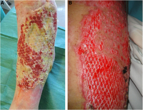 Figure 12 Cryopreserved meshed de-epidermized dermis integration onto the wound bed of a leg ulcer (A) and a full-thickness burn (B).