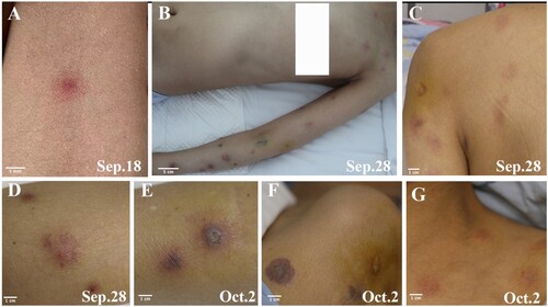 Figure 3. Cutaneous lesions evolution throughout disease progression. A: Onset of red papules located on the medial left forearm. B, C: Development of purplish-red plaques and subcutaneous nodules on the left forearm, left anterior chest wall, and left upper back. D: Appearance of erythematous subcutaneous nodules on the inner left forearm. E, F: Presence of a purpuric plaque with necrotic centre on the left forearm. G: Erythematous subcutaneous nodule on the left anterior chest wall.
