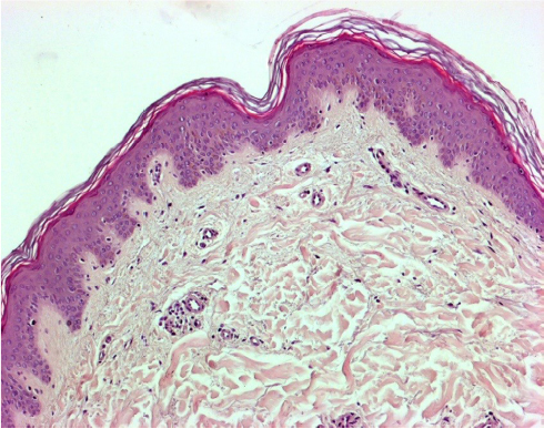 Figure 5 Skin allograft histopathologic study (hematoxylin and eosin staining) after 15 days of storage at −80°C (original magnification 100×): morphology of skin layers is preserved.