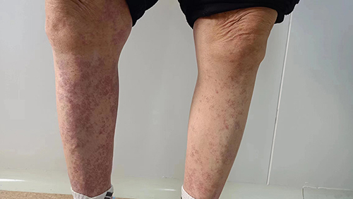 Figure 2 Gross photographs of the patient’s lesions on both lower limbs.