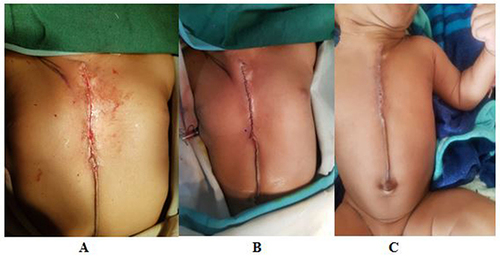 Figure 5 Postoperative: (A) the incision closed layer by layer, cleaned; (B) observed for infection at 2–7 days; (C) at discharge.