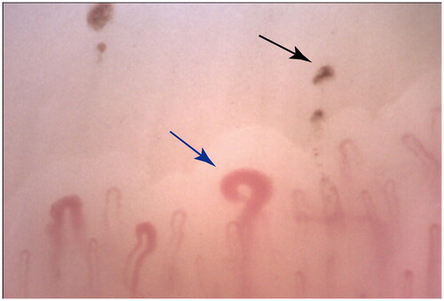 Figure 1. Typical Nailfold Videocapillaroscopy Finding in Patient with MCTD. Blue and black arrows are used to denote giant capillaries and microhemorrhages, respectively.