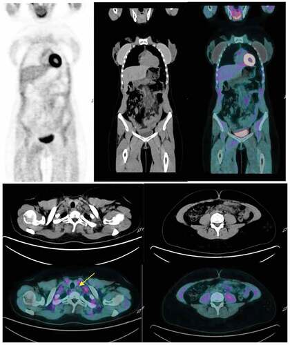 Figure 2. (a,b,c) Follow-up FDG PET/CT 8 weeks after vaccination reveals normalization of FDG uptake in cervical (yellow arrow) and abdominal lymph nodes.