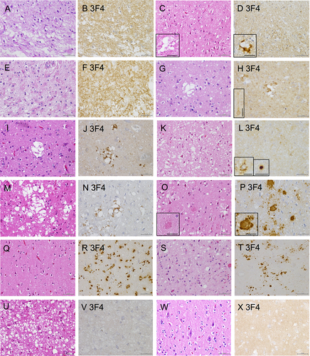 Figure 5. Histological findings of the prion disease cases. (A, C, E, G, I, K, M, O, Q, S, U, W: Hematoxylin and eosin staining (HE), B, D, F, H, J, L, N, P, R, T, V, X: Immunohistochemistry (IHC) with 3F4), (A, B: sporadic Creutzfeldt–Jakob disease case 1 (sCJD 1), C, D: sCJD 2, E, F: sCJD 3, G, H: sCJD 4, I, J: sCJD 5, K, L: sCJD 6, M, N: sCJD 7, O, P: Gerstmann–Sträussler–Scheinker disease case 1 (GSS 1), Q, R: glycosylphosphatidylinositol-anchorless prion disease case 1 (GPIALP 1), S, T: V180I CJD 1 (treated with pentosan polysulfate (PPS)), U, V: V180I CJD 2 without PPS, W, X: non prion case: control 3). (A, B: sCJD 1) HE staining indicating neuronal loss, gliosis and spongiform changes (a). IHC with 3F4 displaying synaptic prion protein (PrP) deposits in the cerebral cortex (b). (C, D: sCJD 2) HE staining shows spongiform changes and some large confluent vacuoles (inset) (c). 3F4 reveals synaptic PrP and perivacuolar PrP deposits (inset) (d). (E, F: sCJD 3) HE staining indicating neuronal loss, gliosis and spongiform changes (e). 3F4 displaying synaptic PrP deposits in the cerebral cortex (f). (G, H: sCJD 4) HE staining shows spongiform changes and some large confluent vacuoles (g). 3F4 reveals synaptic PrP deposits, perivacuolar PrP deposits and perineuronal PrP deposits (inset) (h). (I, J: sCJD 5) HE staining shows spongiform changes and some large confluent vacuoles (I). 3F4 reveals synaptic PrP and perivacuolar PrP deposits (j). (K, L: sCJD 6) HE staining shows spongiform changes (k). 3F4 reveals synaptic, perineuronal (inset), and plaque-type deposits (inset) (l). (M, N: sCJD 7) HE staining shows spongiform changes, gliosis, and large confluent vacuoles (m). 3F4 reveals PrP perivacuolar and diffuse synaptic deposits (n). (O, P: GSS 1) HE staining shows spongiform changes and PrP plaques (inset) (o). 3F4 reveals numerous PrP plaques (inset) and synaptic deposits (p). (Q, R: GPIALP 1) HE staining shows minimal spongiform changes and only mild neuronal loss (q). 3F4 reveals numerous PrP coarse granular deposits in the neuropil and around the vessels (r). (S, T: V180I CJD 1 treated with PPS) HE staining shows spongiform changes and gliosis (s). 3F4 reveals synaptic deposits and many PrP coarse deposits (t). (U, V: V180I CJD 2 without PPS) HE staining shows extensive and severe spongiform changes (u). 3F4 shows virtually no abnormal PrP deposits (v). (W, X: non prion case: control 3) HE shows that the neurons and neuropil are preserved, and there is no obvious neurodegenerative pathology (w). 3F4 shows a weak positive PrP staining in the cortex (x). (Scale bars: A-V: 50 µm, inset: C, D, H, O, P: 25 µm, L: 20 µm).