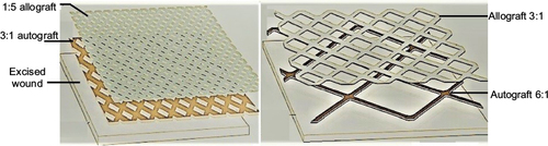 Figure 11 “Alexander” original technique: meshed allograft overlay of an underlying meshed autograft (A). “Sandwich technique”, variant of “Alexander” original technique (B).
