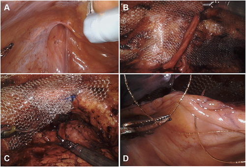 Figure 1 Unilateral indirect inguinal hernia repair during robot-assisted radical prostatectomy. Image of an indirect inguinal hernia fascia defect (A). Mesh application around the inguinal hernia defect (B). Mesh fixation to Cooper’s ligament (C). Covering the mesh with peritoneum (D).