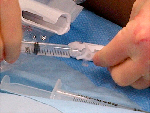 Figure 5 Picture showing connection of syringe containing sclerosant to treatment device.