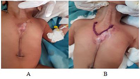 Figure 2 Preoperative: (A) defect on the anterior chest wall with scar-like hypopigmented skin and supraumbilical raphe; (B) marked V-shaped sternal defect.