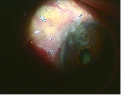Figure 12 Patch graft of the amniotic membrane on the denuded sclera after pterygium excision.