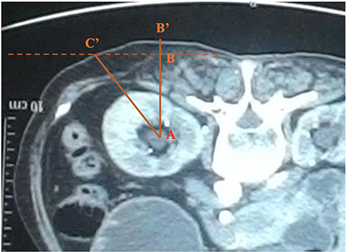 Figure 4 The way to determine (A, B and C) on CTScan based on the principle of right triangles.