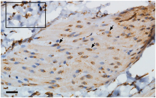 Figure 2. Application of the anti-iNOS antibody from Santa Cruz elicited a perinuclear immunoreactivity in the detrusor (arrowhead). Inlet: immunoreactivity noted in the lamina propria of the urinary bladder. Scale bar: 20 µm.