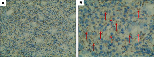 Figure 4 IHC analysis showing an abundance of syphilis spirochetes in the mucosal lamina propria and glands. (A) Low magnification (original magnification ×100); (B) high magnification (original magnification ×400) (Red arrows: syphilis spirochetes).