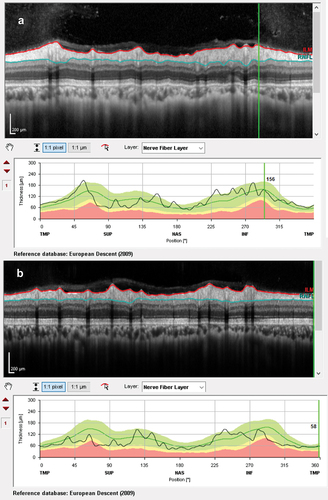 Figure 5. Optical coherence tomography retinal nerve fibre layer thicknesses at 2 months, following treatment: (a) right eye and (b) left eye.