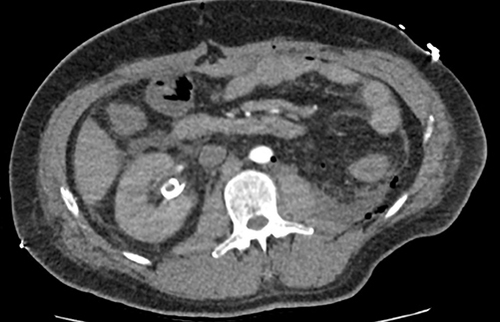 Figure 5 An axial section from a non-contrast abdominal CT showing an appropriately positioned right sided ureteric stent without hydronephrosis.