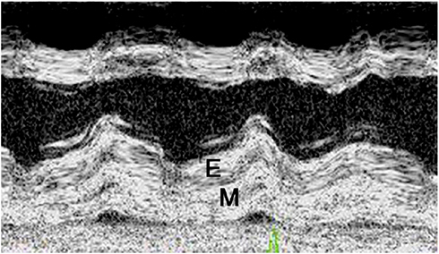 Figure 3 M-Mode view showing the layering of the posterior LV wall with a cleavage line between the endocardium (E) and the myocardium (M).