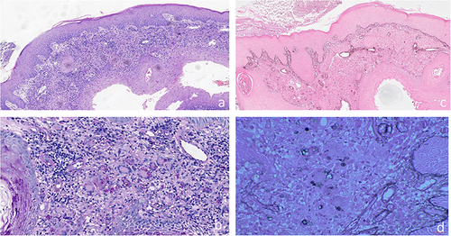 Figure 2 Histological Features of the Patient. (a) Pseudoepitheliomatous hyperplasia and granulomatous inflammation accompanied by localized necrosis and abundant inflammatory infiltration (H&E, magnification ×50). (b) Numerous morula-like formations highlighted through Periodic Acid-Schiff staining (magnification ×200). (c) Acid-fast stain: negative (magnification×50). (d) hexamine silver stains: positive (magnification ×200).