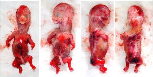 Figure 4. 14 weeks fetus from the second pregnancy of the couple. The fetus, female, presented with facial edema, long neck, low-set and small ears, micrognathia, narrow thorax, mesomelic and rhizomelic shortening of the limbs.