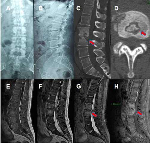 Figure 1 X-ray images showed uneven density and narrowing of the L2/3 intervertebral space (A and B). CT showed a cavity in the L2/3 segment of the vertebra, bone destruction involving most of the vertebra, and multiple irregular sequestrum (red arrow) within the lesion (C and D), Sagittal MRI showed vertebral body and intervertebral disc low T1 signal and high T2 signal. After enhancement, the abscess wall was significantly enhanced (E–H).
