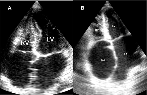 Figure 5 AP4 view: (A) view of a case of right ventricular (RV) EMF. (B) Shows a case of biventricular EMF of both RV and LV.