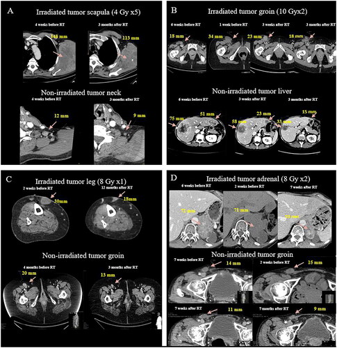 Figure 2. CT scans demonstrating the four patients (A, B, C, D) in the RT + ICI(salvage) cohort that received RT to progressing melanoma metastases and experienced tumor shrinkage in non-irradiated metastases.