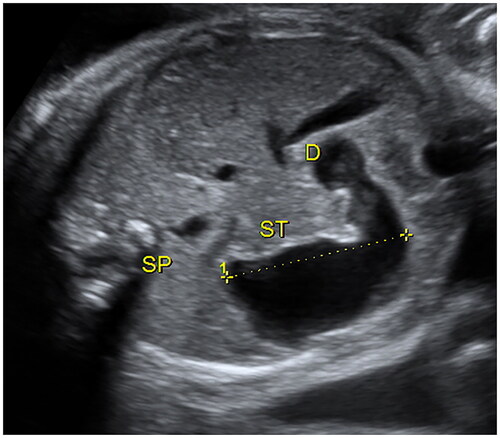 Figure 2. Measurement of the longitudinal dimension of dilated stomach by ultrasound.