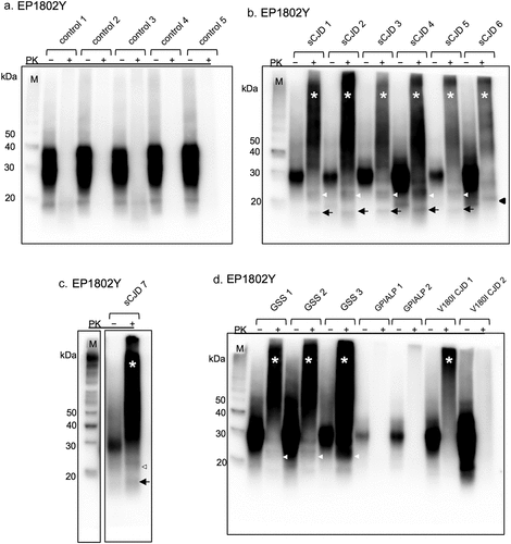Figure 3. Western blot analyses of the formalin-fixed paraffin-embedded (FFPE) samples with the EP1802Y anti-prion protein (PrP) antibody. (a) in control cases, proteinase K-untreated (PK [−]) samples show PrP signals at 25–40 kDa. In proteinase K-treated (PK [+]) samples, there is no PrPres signals. (b, c) the PK (+) samples of sporadic Creutzfeldt–Jakob disease (sCJD) 1–7 show unglycosylated PK-resistant PrP (PrPres) signals at 21 kDa (case 1–5 and 7: white arrowheads) and about 19 kDa (case 6: arrowhead). High molecular smear PrPres signals are observed in all sCJD cases (*). In addition, a low molecular weight band at approximately 16 kDa (arrows) are also found in sCJD cases 1–5 and 7. The 16 kDa PrPres signal is not observed in sCJD 6. (D) in the Gerstmann–Sträussler–Scheinker disease (GSS) cases, unglycosylated PrPres at 21 kDa (white arrowheads) and high molecular smear bands are present (*). The low molecular weight band at approximately 8 kDa is not detectable. In glycosylphosphatidylinositol-anchorless prion disease (GPIALP) cases, no PrPres signal is detected. In the PK (+) sample of V180I CJD 1 (pentosan polysulfate [PPS]-treated case), a high molecular smear band (*) is visible, whereas the PrPres signal is substantially weak in V180I CJD 2 (PPS-untreated case).