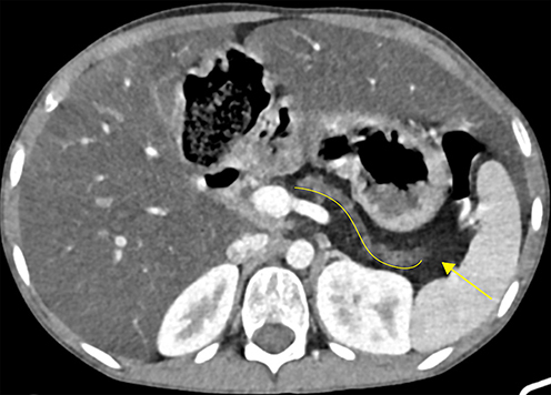 Figure 4 CECT at the level of the pancreatic body and tail showing a completely atrophied pancreas, with pancreatic duct ectasia (curved solid line) surrounded by complete fatty replacement (solid arrow). The former two might signify evidence of chronic pancreatitis.