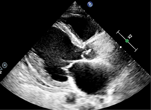 Figure 2 Cardiac ultrasound on the 15th day of admission (left ventricular long axis section).