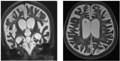 Figure 2. MRIb from June 2019 shows cortical and subcortical atrophy.