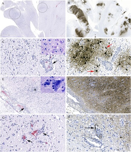 Figure 5. Histopathology and immunohistochemical findings in the brain tissue from a red fox. A. Multifocal areas of necrotizing encephalitis (low magnification, circled). B. Abundant influenza virus antigen (brown deposition) corresponding to areas of inflammation observed in slide A. C. Degeneration of neurons with neutrophil infiltration (circled) and perivascular cuffing with inflammatory cells (black arrow). Inset: Multiple pale eosinophilic neurons with karyolytic nuclei indicating degeneration and presence of neutrophils. D. Abundant viral antigen was detected and corresponds with histologic lesions observed in slide C (red arrows). E. Meningitis (arrow) and areas of increased cellularity due to gliosis and inflammatory cells infiltrate (*). Inset: Neuronophagia. F. Abundant viral antigen in the brain corresponding to areas of inflammation shown in E. G. Vasculitis (arrows). H. Viral antigen detected in endothelial cells (arrow).