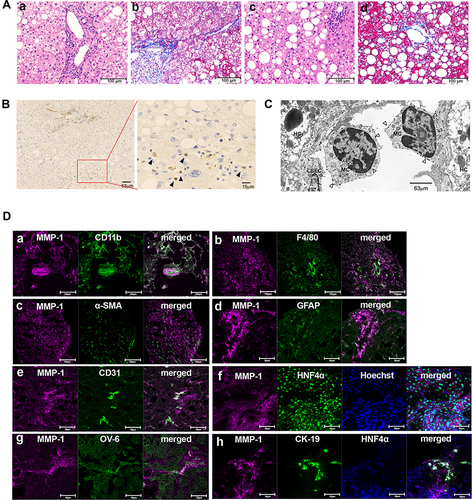 Figure 1 Identification of MMP-1-positive cells in early stage of nonalcoholic steatohepatitis (NASH) livers. (A) Hematoxylin and eosin (H&E) staining (a and c) and Azan-Mallory staining (b and d) of liver tissues from representative early-stage NASH patients are shown. Scale bar, 100 μm. (B) Immunohistochemical staining showing matrix metalloproteinase (MMP)-1-expressing cells (arrowheads). Scale bars, 63 μm in the left panel and 15 μm in the magnified right panel. (C) Immunoelectron microscopy (IEM) showing MMP-1-positive gold grains (arrowheads) on the surface of monocytes (MC). Scale bar, 63 μm. (D) Confocal laser-scanning microscopy showing co-expression of MMP-1 and the indicated cell markers. Scale bars, 100 μm in a to c, and 50 μm in d to h.