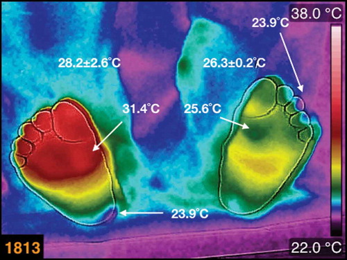Figure 5. The thermogram of the plantar skin of a female, diabetic patient, 60 years old, BMI 24.7 kg/m2, 8 years with diagnosis of diabetes mellitus. The average temperatures are written above each foot. The small cold regions on the third toe of the left foot, and on the medial-posterior part of the heel of the right foot, are identified by arrows.