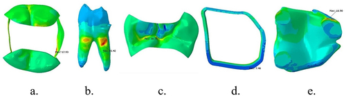 Figure 4 Stress distribution after lateral loading on lower first molar with MOD cavity and polyethylene fiber reinforced composite on (a) enamel, (b) dentin, (c) packable composite, (d) polyethylene fiber wallpapering the cavity wall, and (e) polyethylene fiber wallpapering the cavity floor.
