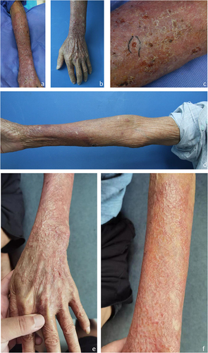 Figure 1 Clinical photos of the patients. (a–d) Diffuse infiltrated erythematous plaques observed on the dorsal side of the left forearm and back of the left hand. These plaques are accompanied by multiple insect-bite-like erosions, ulcers, papules, pustules, atrophic scars, and scabs within the affected area. (e and f) Following a 3-month treatment of oral terbinafine at a dosage of 250 mg/day combined with topical 1% naftifine-0.25% ketoconazole cream, an improvement in skin lesions was observed. Fibrotic scars emerged on the flexor aspect of the left arm as the skin lesions evolved.