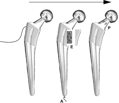 Figure 3 The technology that enables smart orthopedic implants has evolved over several decades, as shown in the total hip prostheses, from tethered electronics (left) to wireless systems that require signal conditioning electronics (E) with antennas (A) to be housed inside the implant (center) to passive sensors (P) that require no electronics and little-to-no modification of the implant (right).