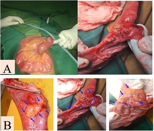 Figure 3 (A) Gross appearance and Cut section of ectopic pancreas as lead point, and (B) blue arrow showed the boundary of pancreatic rest which was lead point.