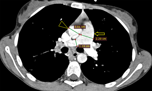 Figure 2 Axial CECT at the level of the main pulmonary artery (MPA) showing enlarged MPA (open arrow) compared to the ascending aorta (triangular open arrow head), measuring 22 mm and 20.1 mm, respectively.