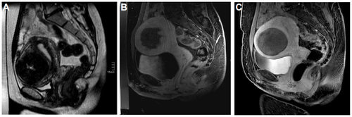 Figure 2 Sagittal T2-weighted MRI for planning purposes (A) shows a homogeneously hypointense UF in the anterior wall. Sagittal T1-weighted, fat-saturated and contrast-enhanced MRI immediately (B) as well as 1 month (C) after the MR-HIFU procedure with a satisfying NPV.