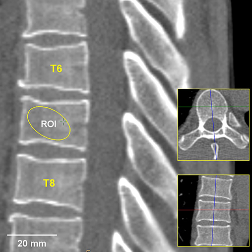 Figure 2 The 7th thoracic vertebra was located and the CT value of mid-sagittal plane was measured in the region of interest (ROI).