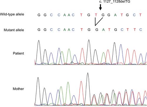 Figure 4 Sanger sequencing of ANTRX2 gene.