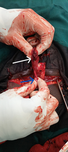 Figure 2 Showing laparotomy findings of ruptured distal tube containing products of gestation (white arrow) and stump from previous tubal ligation (blue arrow).