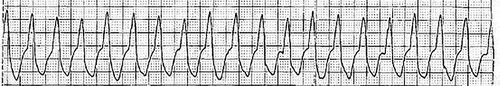 Figure 1. Telemetry showed ventricular tacycardia with heart rate of 149 bpm