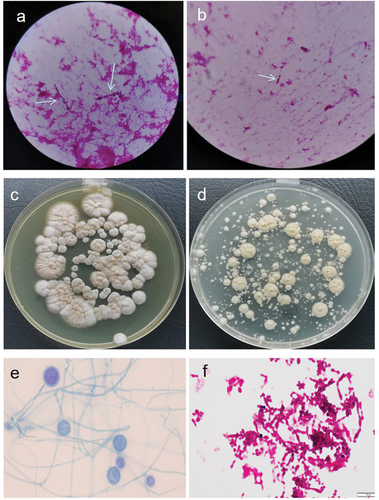 Figure 3. (a, b) Yeast-like spores and hyphae (with an arrow, gram staining, magnification 1,000×) under microscopy with bone marrow cultured at 37 °C in 16 days. (c, d) Colonies grown at 28 °C and 37 °C with bone marrow bone cultured in 16 days; (c) White, short villous and filamentous colonies; (d) Yeast-like colonies. (e, f) Fungal morphology under microscopy by taking colonies, respectively; (e) A filamentous form with tuberculate macroconidia on the septate hyphae (lactic acid phenol cotton blue staining); (f) Yeast-like fungus, budding cells with pseudohyphae (gram staining).