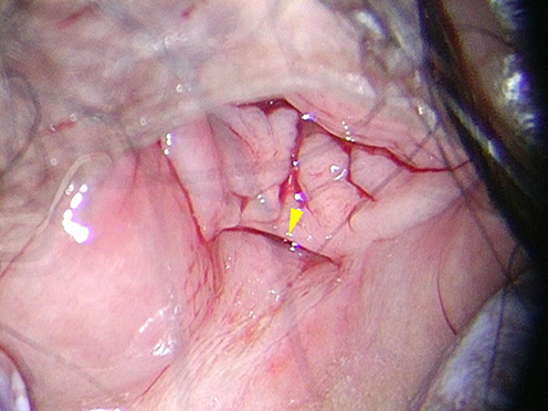 Figure 5 Gynecological examination confirmed the closure of rectovaginal fistula (arrowhead).