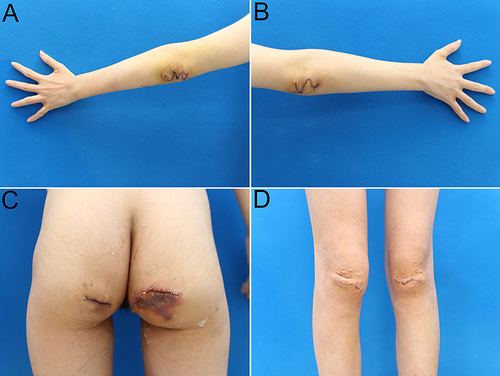 Figure 5 Status of the incisions two days after the operation. (A and B) elbows. (C) buttocks. (D) knees.