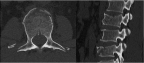 Figure 6 Axial and sagittal CT images: A 48-year-old male patient fell from a height. He had L2 vertebrae injury with subtype A2 and L4 vertebrae injury with subtype A1.