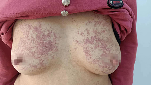 Figure 1 Gross photographs of the patient’s bilateral breast lesions.